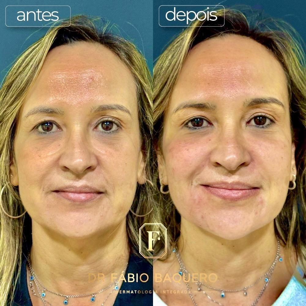 Antes e depois de paciente: pele mais uniforme e contorno do rosto mais definido