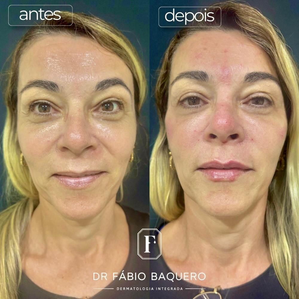 Antes e depois de paciente: rosto com mais firmeza e lábios mais definidos