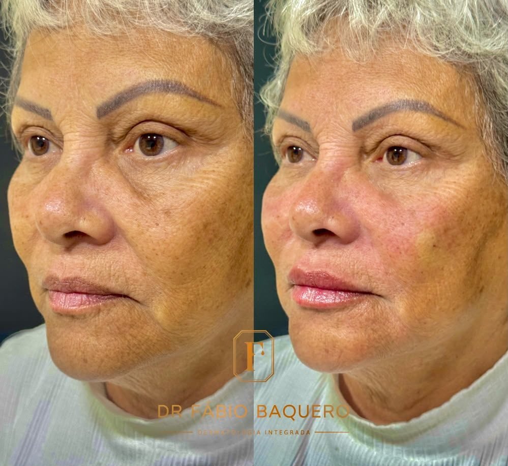 Antes e depois de paciente em perfil: pele com mais viço e sulcos suavizados